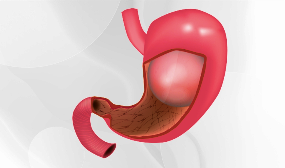 Intragastric Balloon